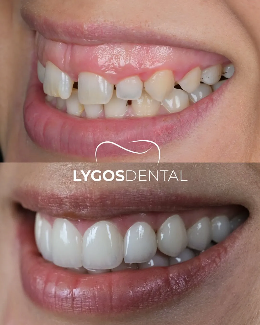 laminate vener before after results