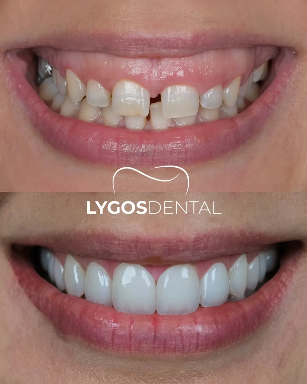 laminate vener before after results