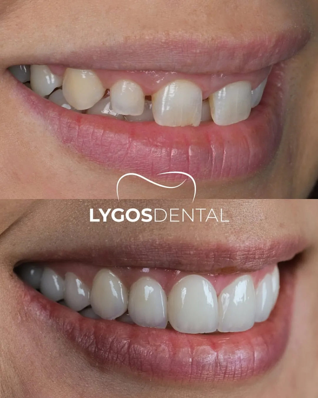 laminate vener before after results