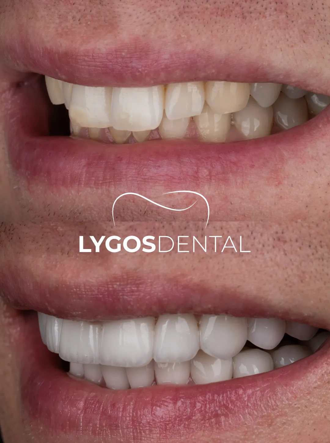 laminate veneer results before and after