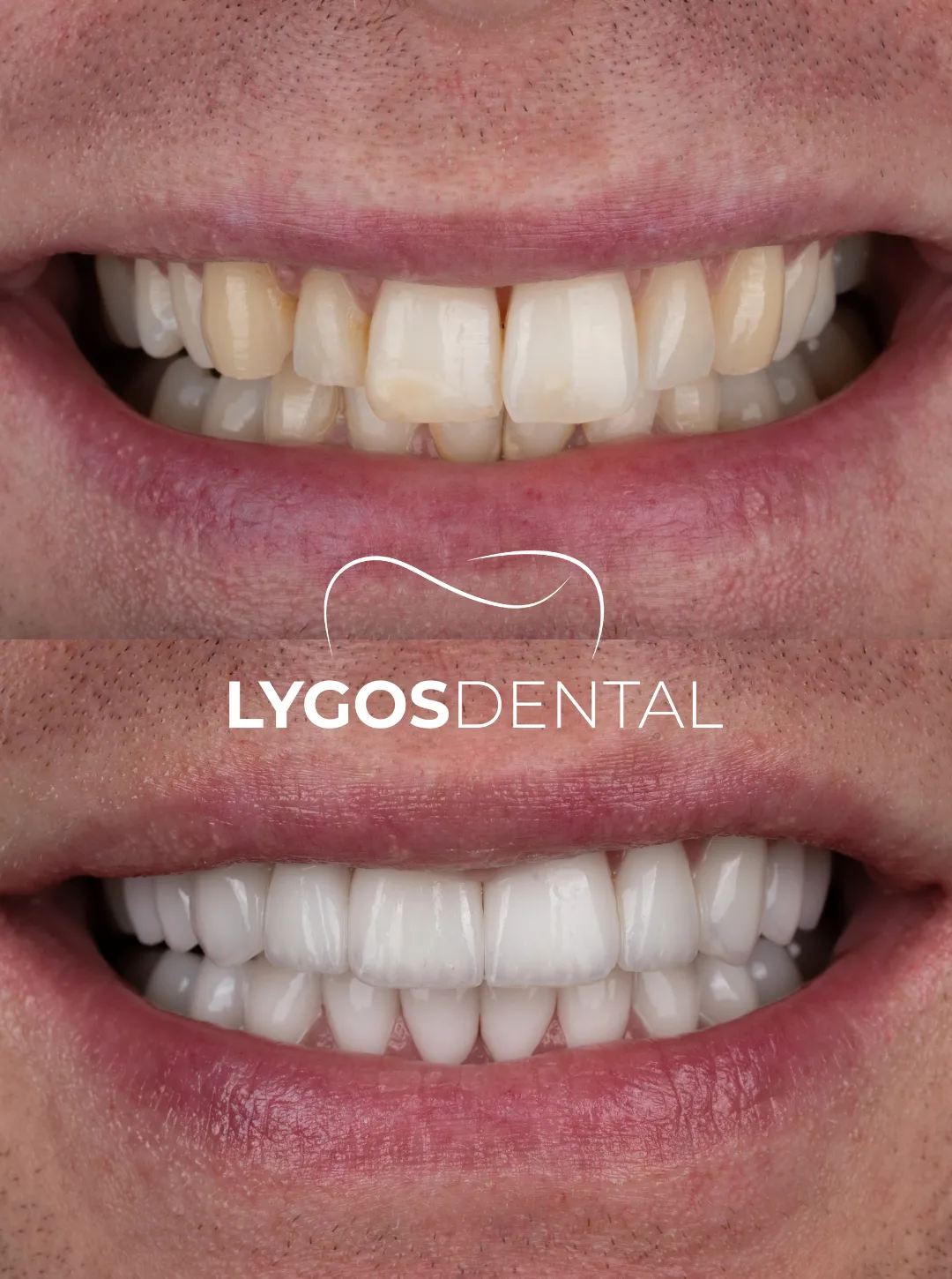 laminate veneer results before and after