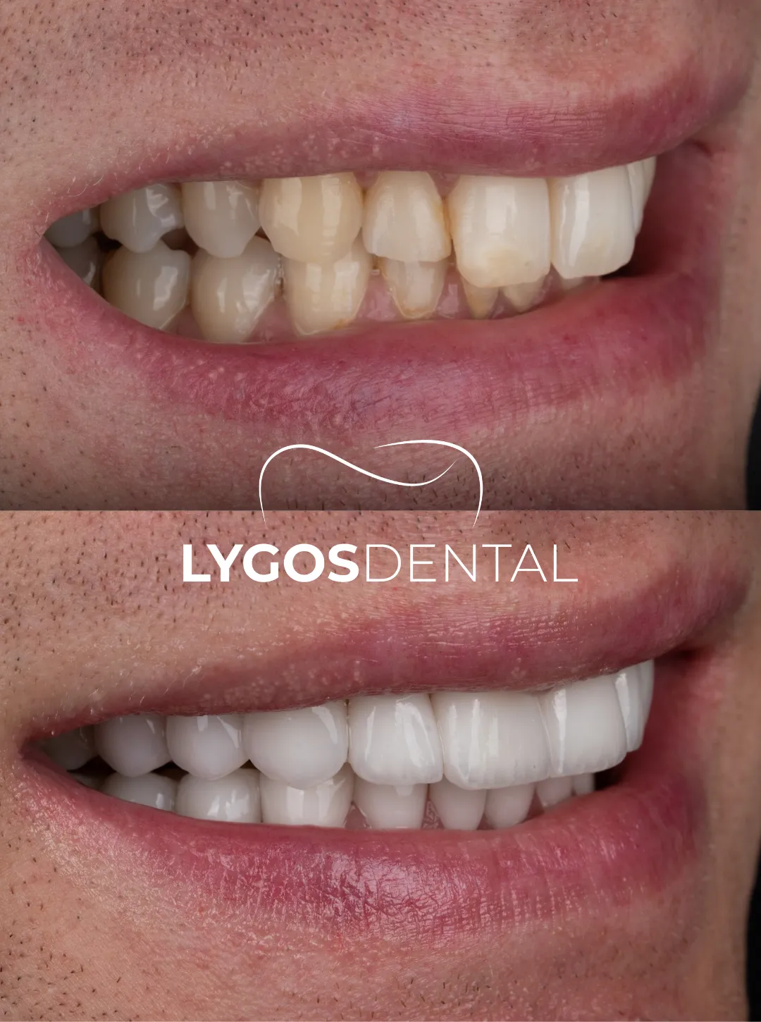 laminate vener before after results