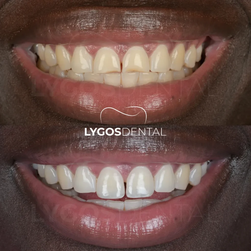 professional teeth whitening process at lygos dental