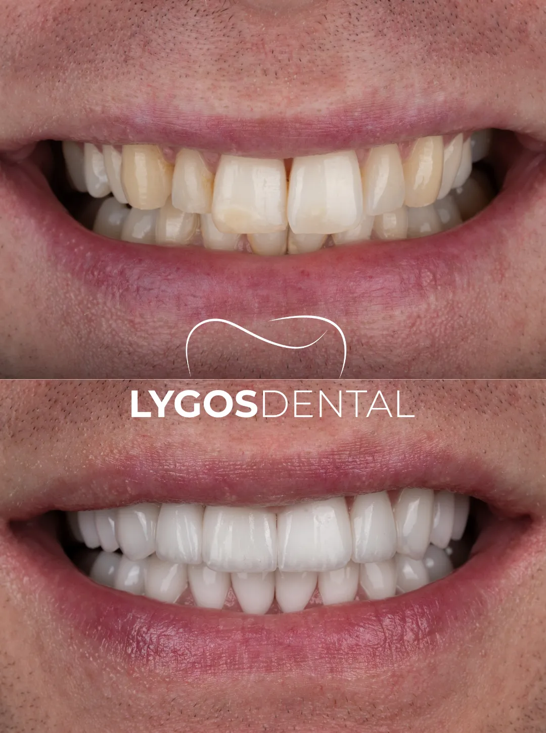 laminate vener before after results