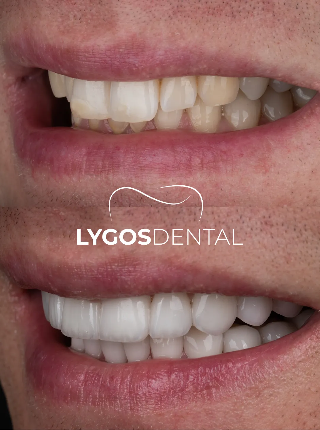 laminate vener before after results