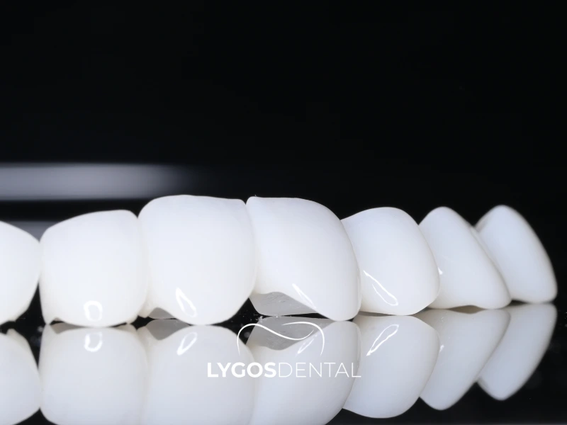 Faccetta Emax 2026 | LYGOS DENTAL