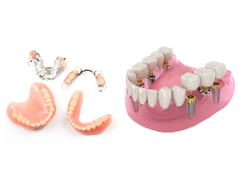 Impianti vs protesi dentarie | LYGOS DENTAL