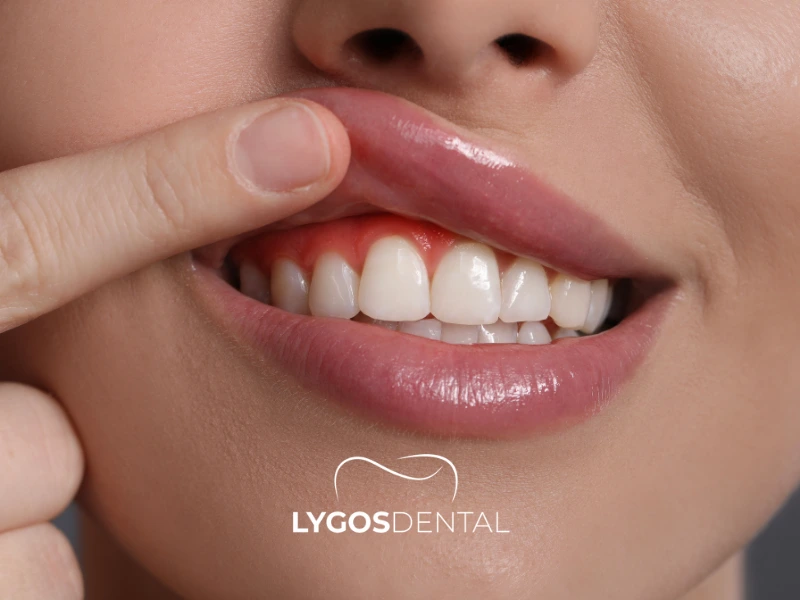 Rischi di infezione dopo l’inserimento di impianti dentali | LYGOS DENTAL