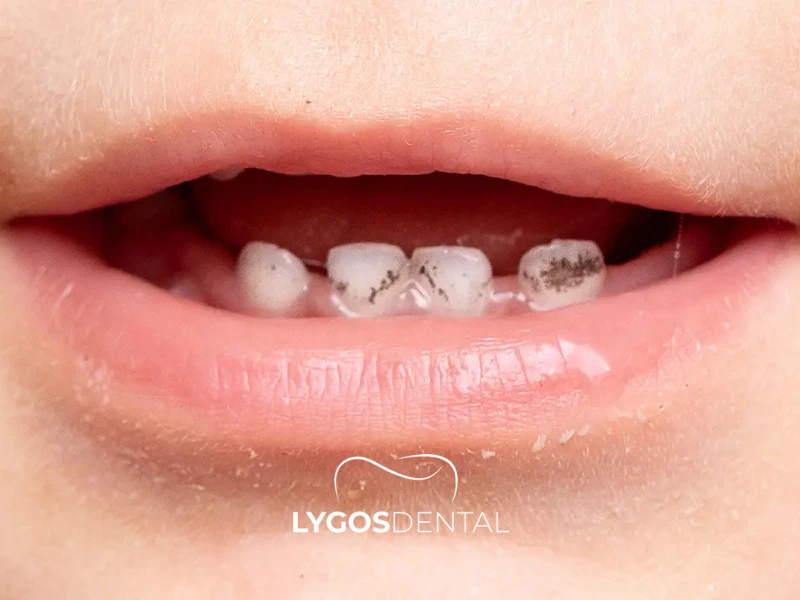 Metodi per prevenire la carie nei bambini | LYGOS DENTAL