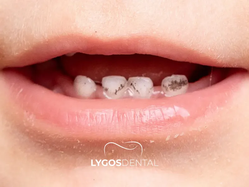 Métodos para prevenir la caries dental infantil | LYGOS DENTAL