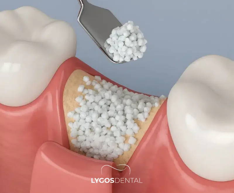 In which situations is a bone graft applied