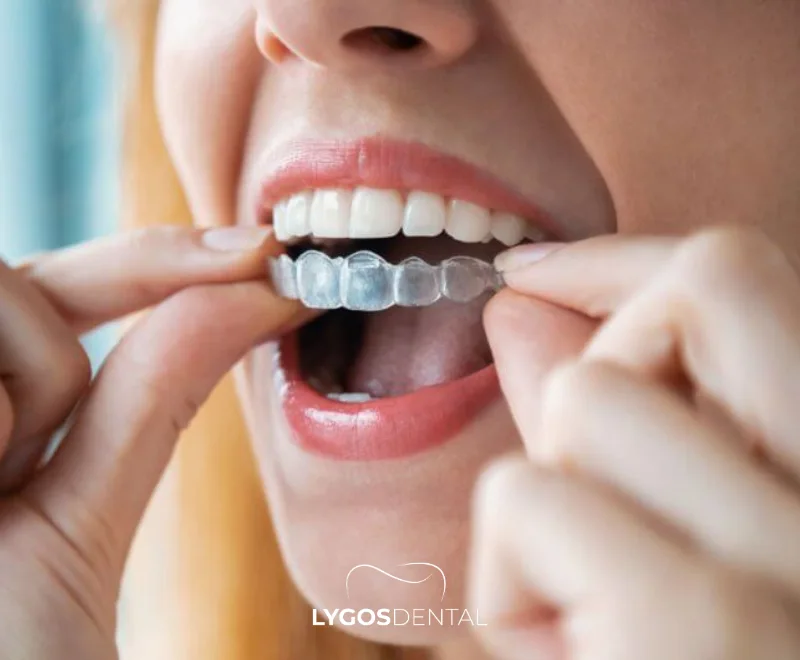 Invisalign Fiyatları Türkiye ve İngiltere