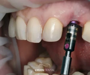 Infection Risks After Dental Implants | LYGOS DENTAL