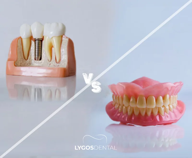 Implant vs Denture