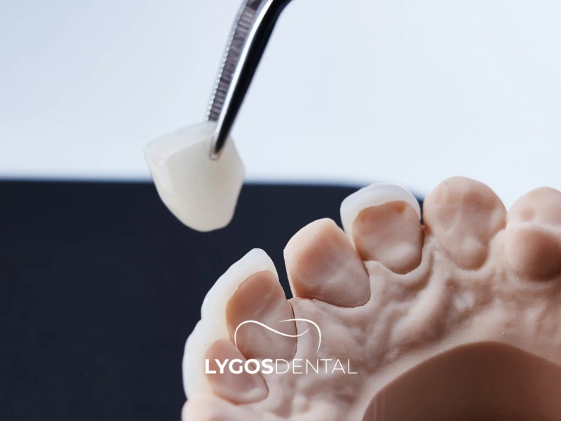 Facettes en porcelaine ou en stratifié | LYGOS DENTAL