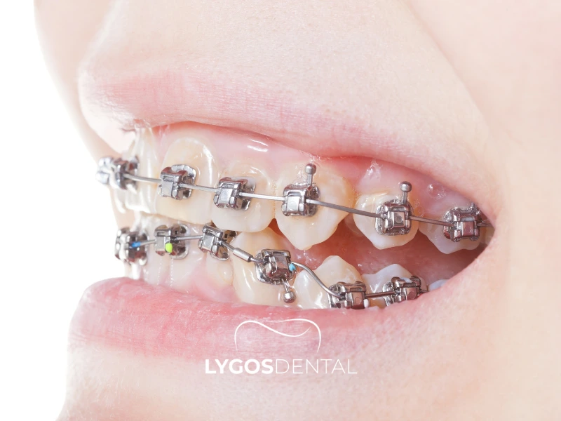 Cosa mangiare durante il trattamento ortodontico | LYGOS DENTAL