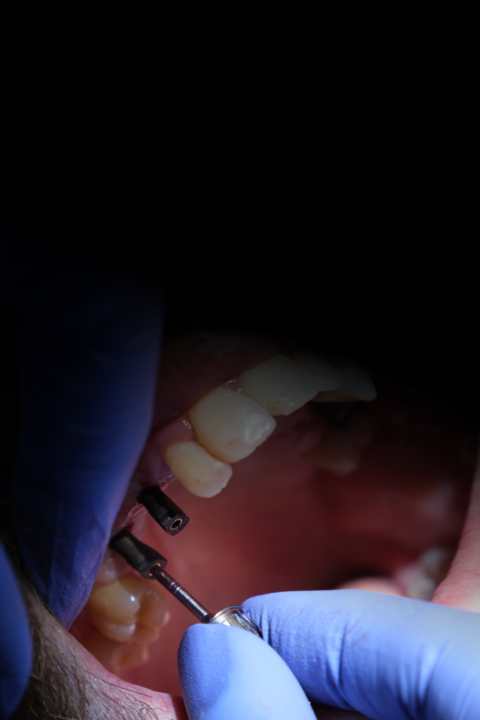 dental implants turkey