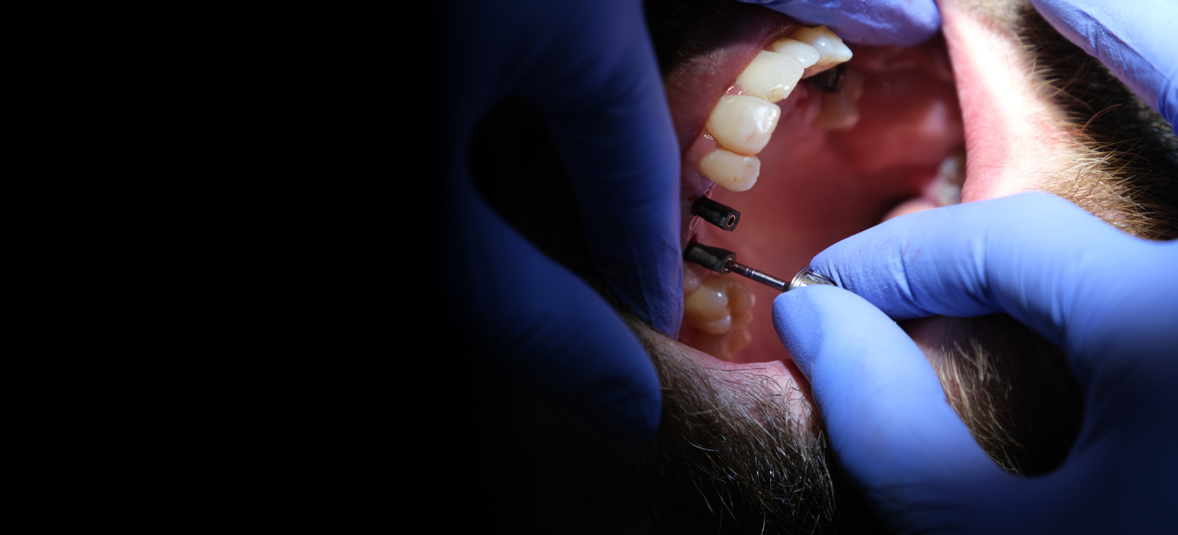 dental implants turkey