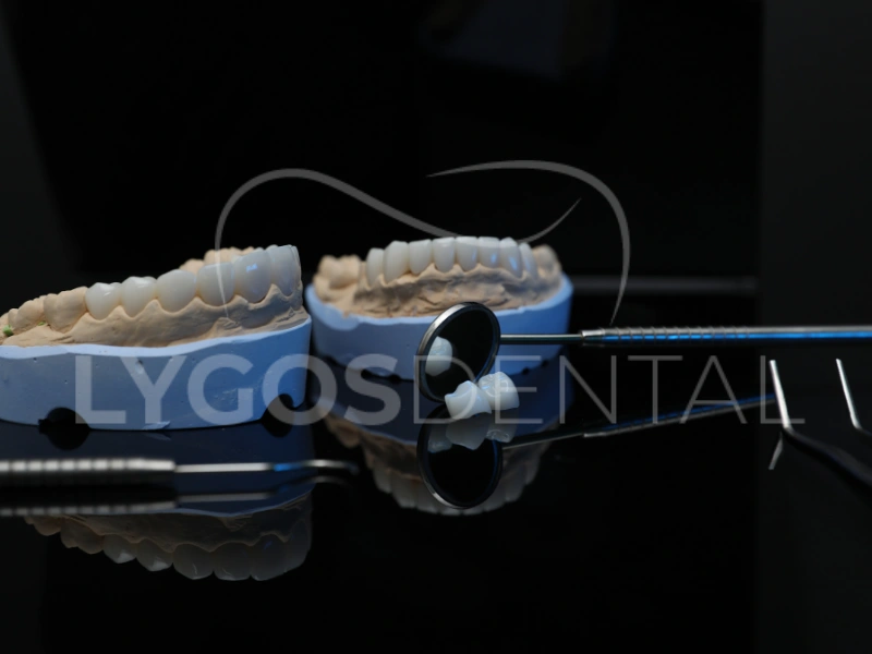 I vantaggi estetici delle corone in zirconio | LYGOS DENTAL