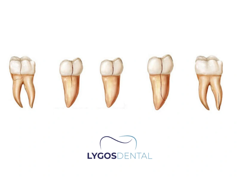 Syndrome de la dent fissurée %sep% %sitename%