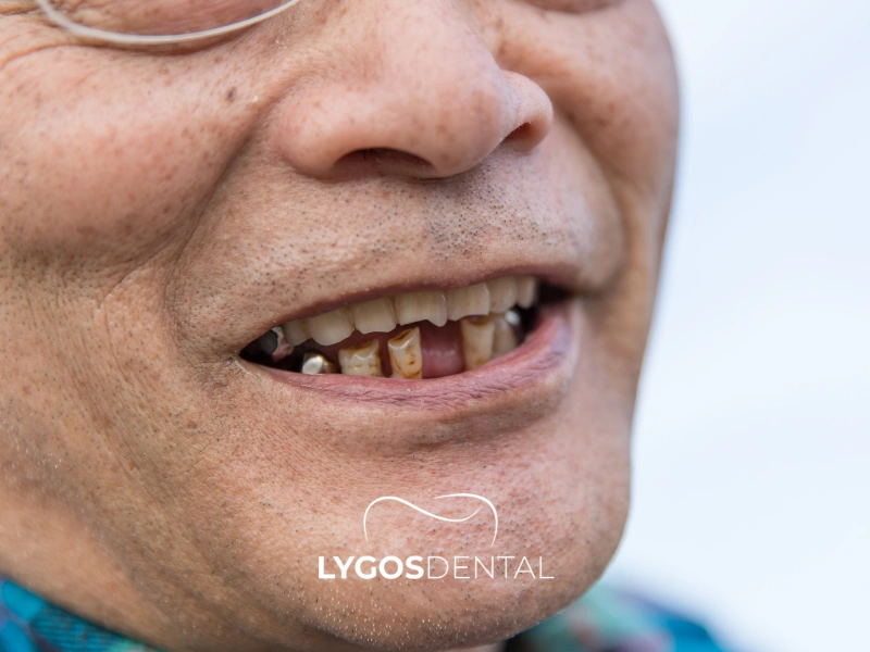In che modo la perdita dei denti influisce sulla pronuncia? | LYGOS DENTAL