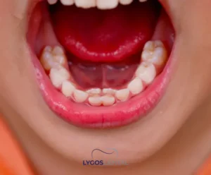 Süt Dişi Düşmeden Kalıcı Diş Çıkarsa Ne Olur? | LYGOS DENTAL