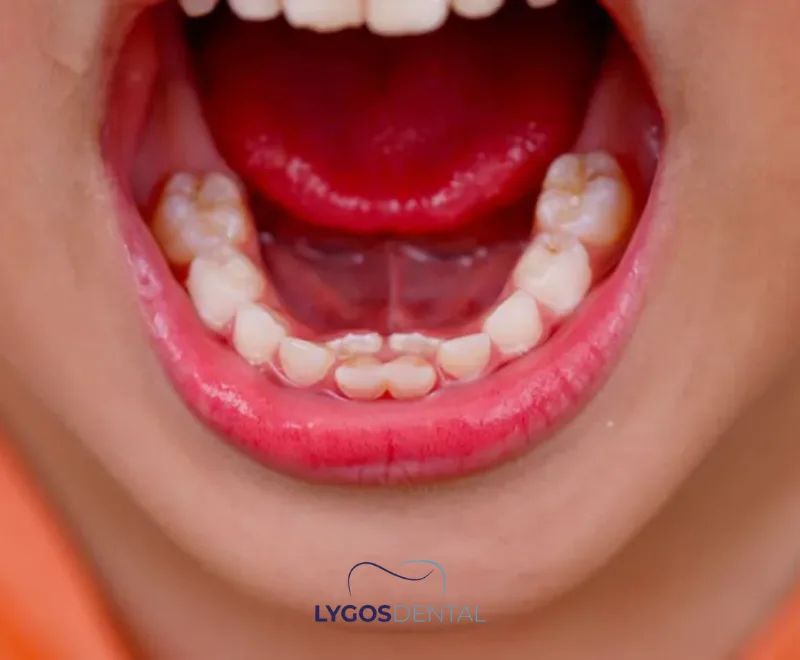Permanent Tooth Before Baby Tooth