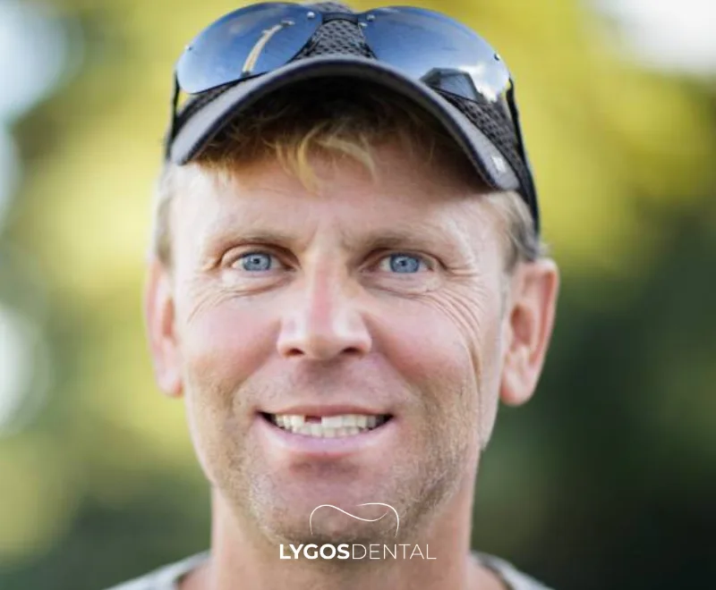 How Does Tooth Loss Affect Speech?