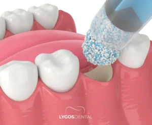 Use of Stem Cells in Dental Treatments | LYGOS DENTAL