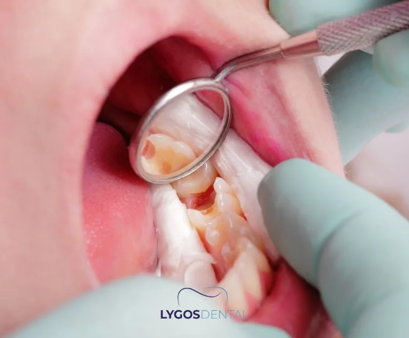 What to Do If a Dental Filling Falls Out