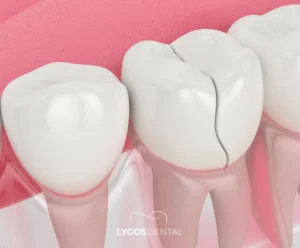 Cracked Tooth Syndrome | LYGOS DENTAL