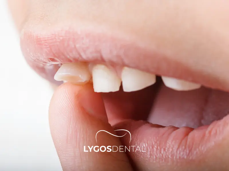 Il dente definitivo prima che il dente da latte cada | LYGOS DENTAL