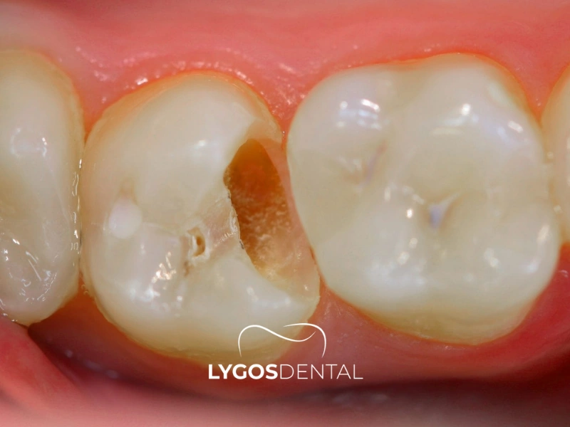 Was tun, wenn eine Zahnfüllung herausfällt? | LYGOS DENTAL