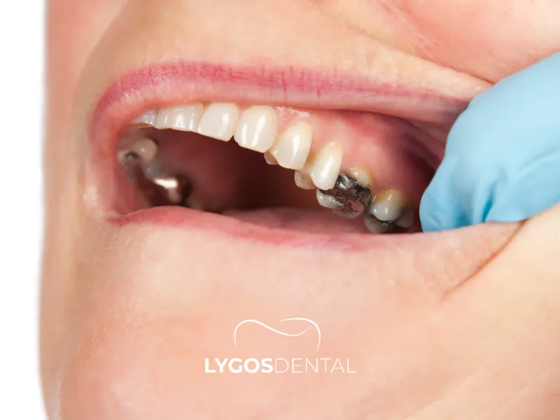 La carie danneggia il cuore? | LYGOS DENTAL