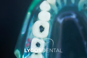 Does Tooth Decay Damage the Heart? | LYGOS DENTAL