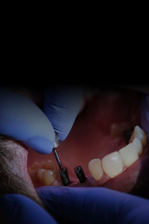 lygos dental multiple tooth implant
