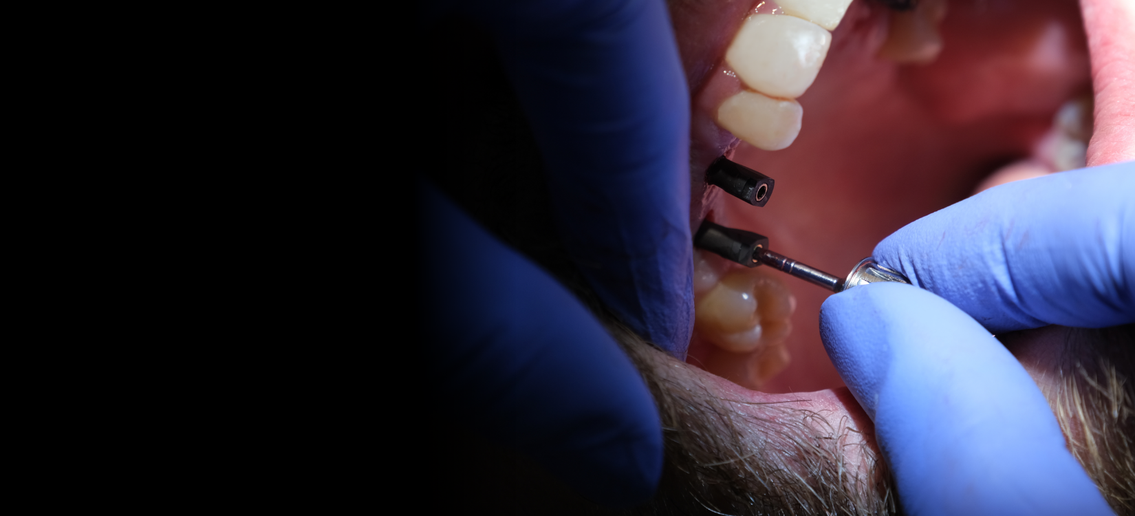 lygos dental multiple tooth implant