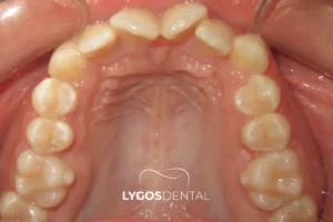 Alveolar Arch: Its Role in Oral Health and Function