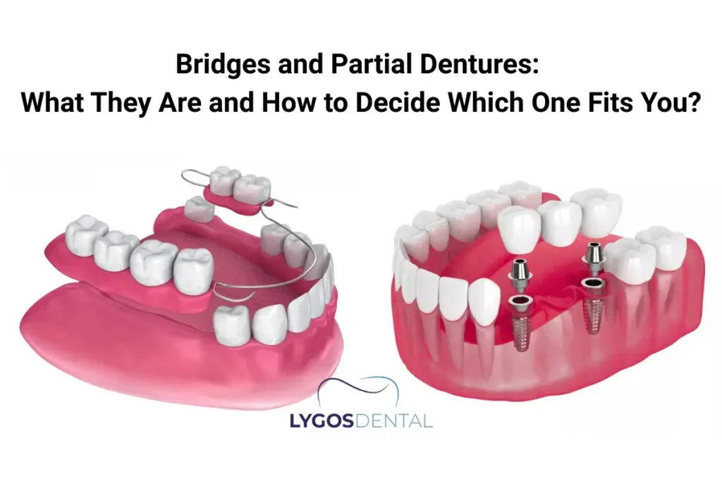 Bridges and Partial Dentures: What They Are and How to Decide Which One Fits You