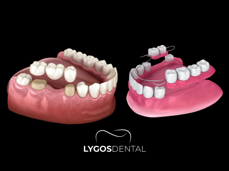 Ponte dentale o protesi parziale: differenze e come scegliere