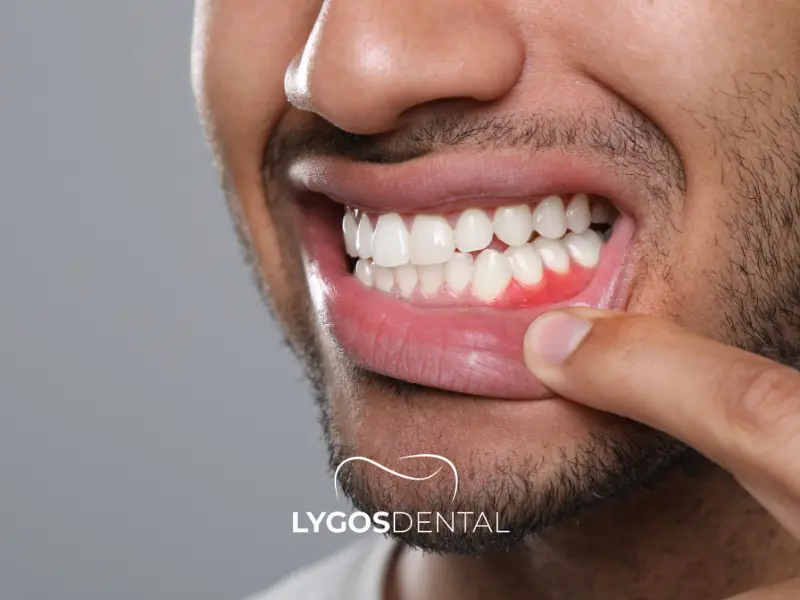 Gengive pruriginose: cause e trattamento