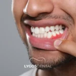 Mâncărimi ale gingiilor: cauze și tratament | LYGOS DENTAL
