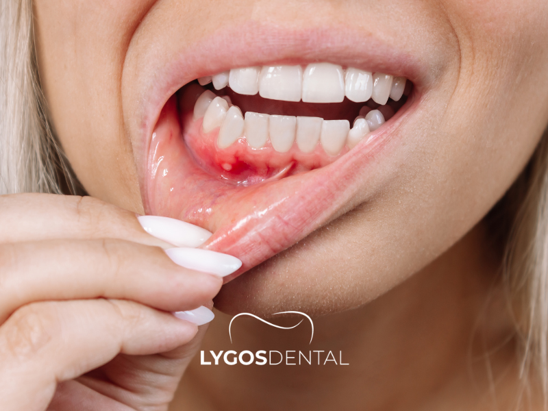 Cosa succede se un dente che dovrebbe essere estratto non viene rimosso?