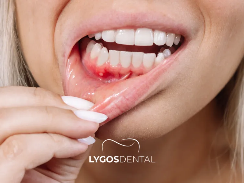 Cosa succede se un dente che dovrebbe essere estratto non viene rimosso?