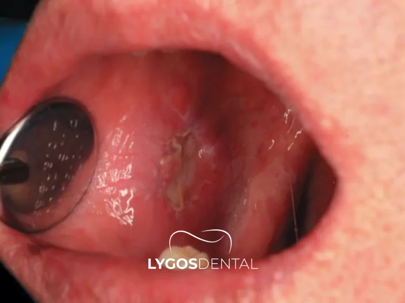 Che cos’è il cancro della mucosa buccale