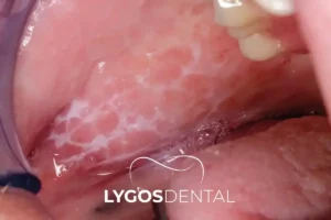 What Is Buccal Mucosal Cancer