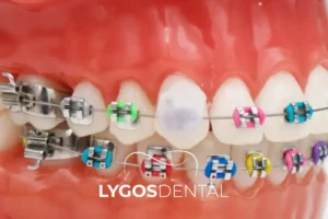 What Is Dental Wax and How to Use It?​ | LYGOS DENTAL