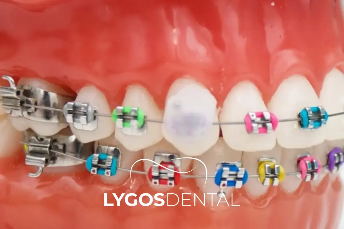 What Is Dental Wax and How to Use It