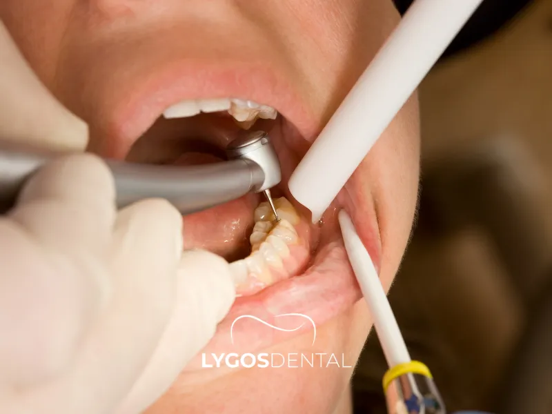 Какво е временна пломба? | LYGOS DENTAL