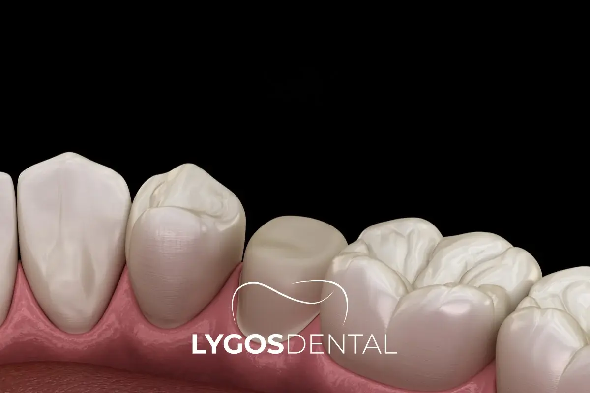 What to Pay Attention to After Tooth Preparation